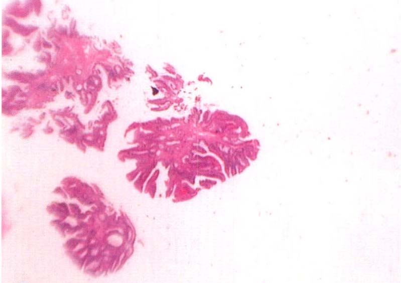 第四章 大腸肛門腫瘤病理圖譜
